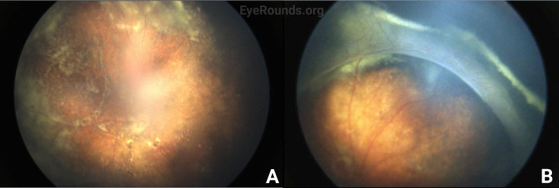 Fundus photographs, right (A) and left (B) eyes.