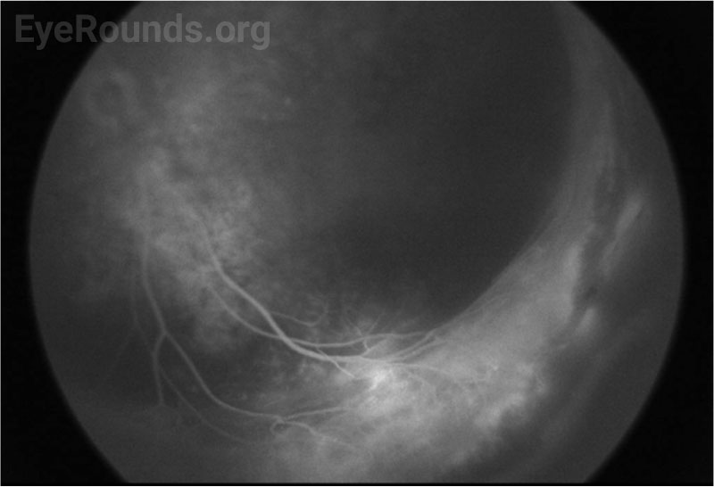 Fluorescein angiography, left eye