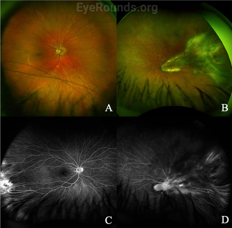 Fundus photography and fluorescein angiography of FEVR, both eyes