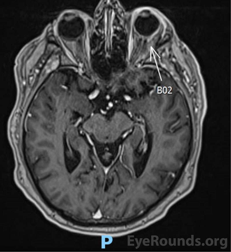 T1-weighted MRI images of the orbit with and without contrast demonstrate contrast enhancement