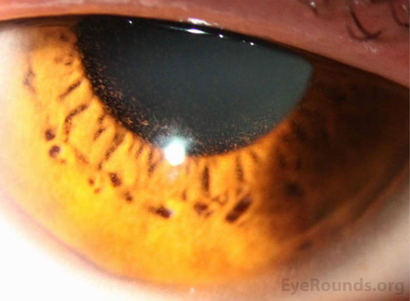 Slit lamp photograph of right eye demonstrated tiny intraepithelial refractile microcysts scattered diffusely across the cornea. The remainder of the cornea appeared normal.