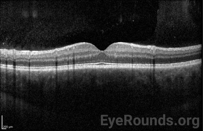 OCT of the right eye showing normal retinal contour and laminations with marked choroidal thickening and congestion. 