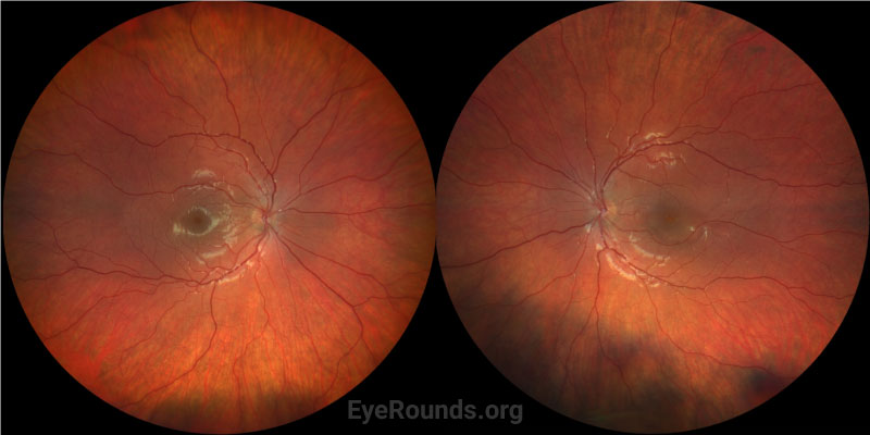 Color fundus photography of both eyes. The right eye shows a normal optic nerve without disc edema and normal foveal light reflex. The left eye shows normal optic nerve without disc edema and blunting of the foveal light reflex corresponding to sub-foveal sub-retinal fluid. 
