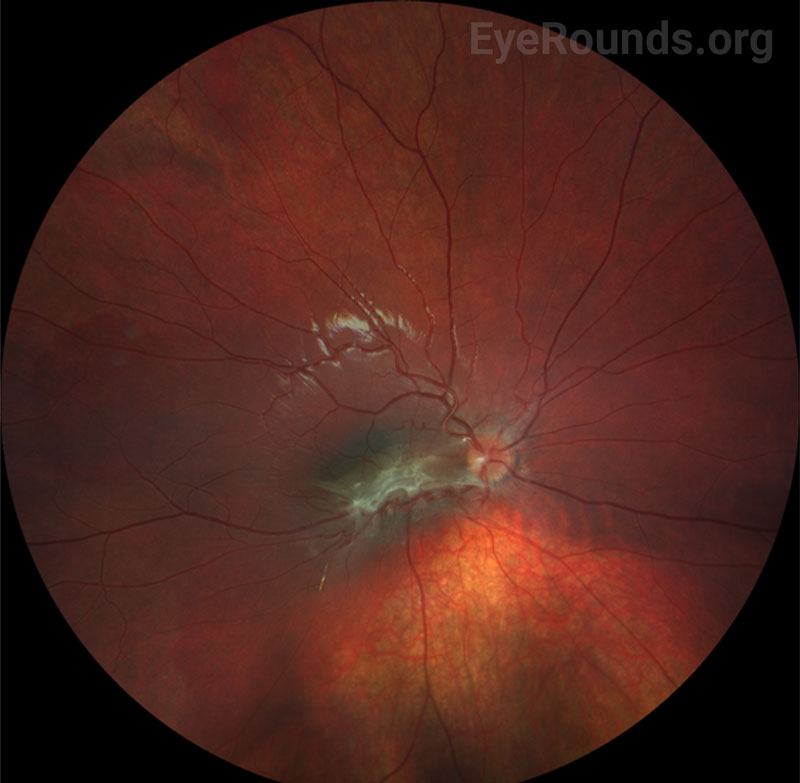 Color fundus photography, right (A) and left (B) eyes. Both eyes demonstrated grade IV optic disc edema with cotton wool spots, peripapillary hemorrhages, and retinal folds. In addition, scattered flame and dot-blot hemorrhages were seen in both eyes.