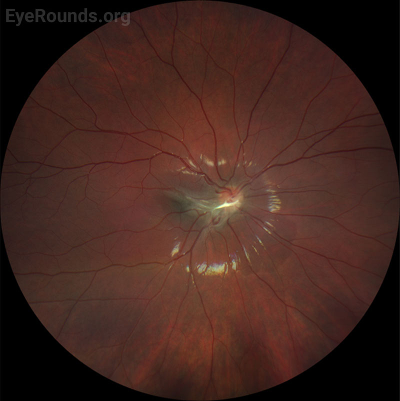 Color fundus photography, right (A) and left (B) eyes. Both eyes demonstrated grade IV optic disc edema with cotton wool spots, peripapillary hemorrhages, and retinal folds. In addition, scattered flame and dot-blot hemorrhages were seen in both eyes.