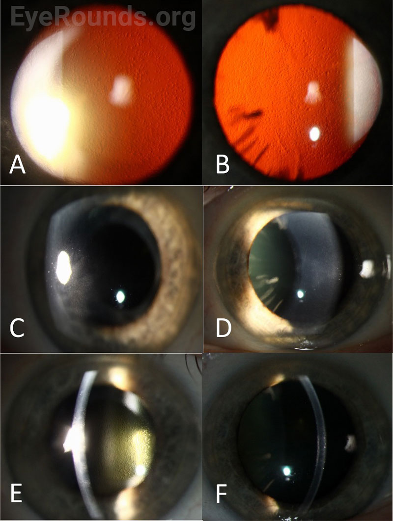 Slit lamp photographs of the right (A, C, E) and left (B, D, F) eye demonstrating diffuse central and peripheral guttae by retroillumination (A, B), corneal haze and edema with 2+ Descemet’s folds (C) and trace Descemet’s folds (D), and corneal edema with deposition of endothelial guttae (E, F).