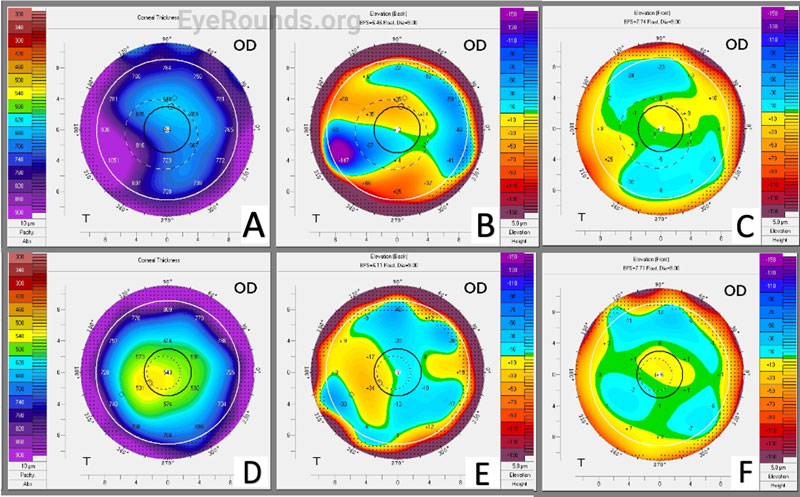 . Corneal tomography of the right eye pre-DMEK (A-C) and post-DMEK (D-F).  Postoperative corneal tomography demonstrates normalization and improved contour of the corneal thickness plot (A,D) and anterior (B, E) and posterior (C,F) elevation maps.