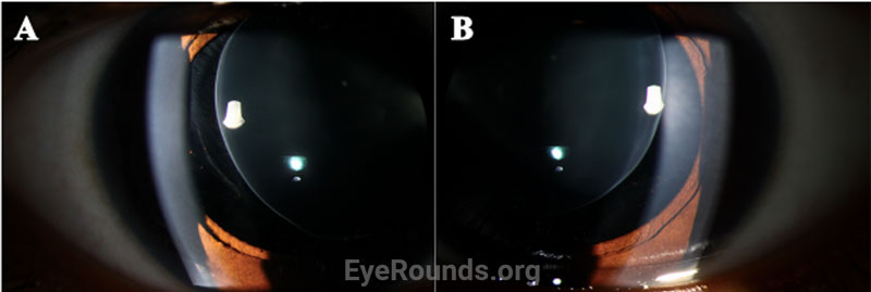 Slit lamp photographs demonstrating superonasal lens dislocation and loose zonules OD (A) and superonasal lens dislocation OS (B).