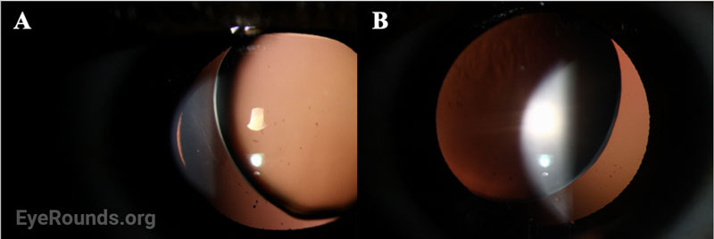 Slit lamp photographs demonstrating superonasal lens dislocation OD (A) and OS (B) on retroillumination.