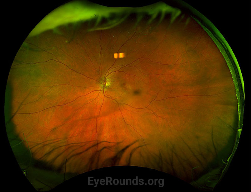 Optos color fundus photography of the left eye at 3-week follow-up. 