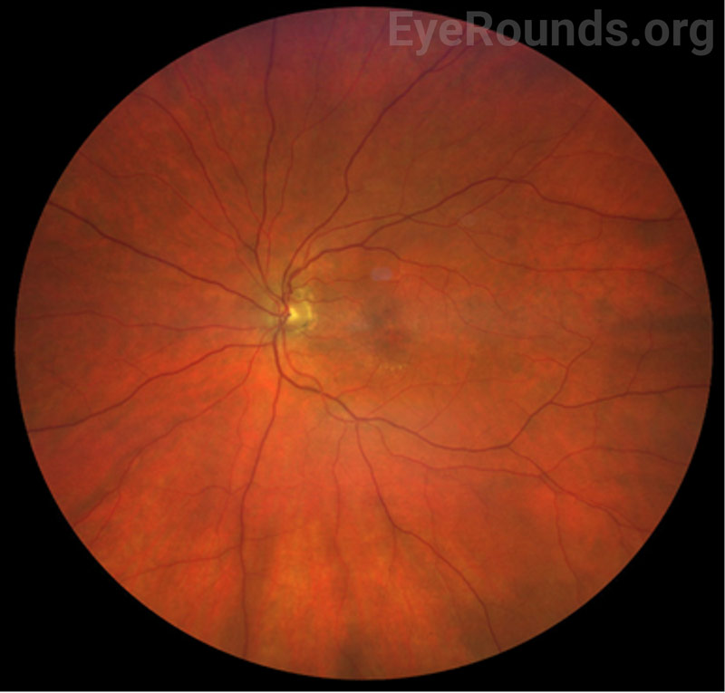 Clarus color fundus photography of the left eye at the 4-month follow-up visit