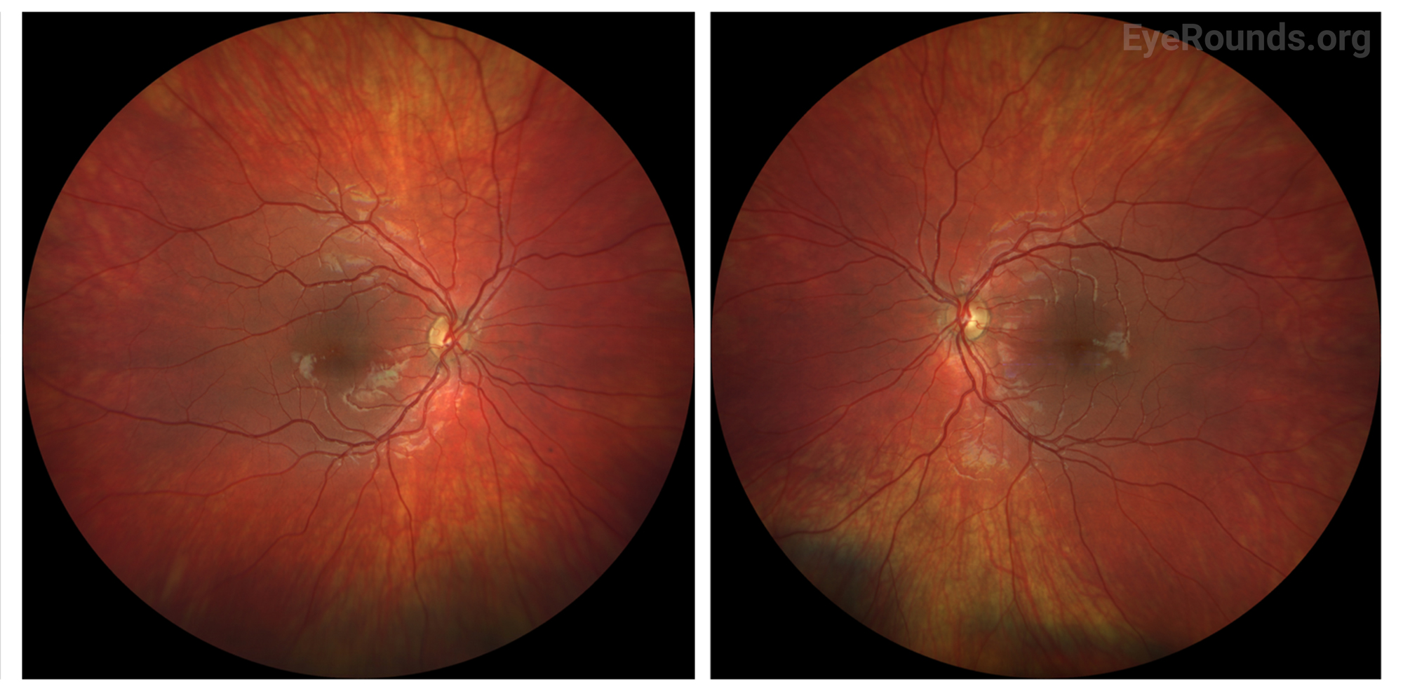 Symmetrical fundus photographs, demonstrating crisp optic nerve margins with normal cup to disc ratio. Vasculature is normal in caliber and course. Choroidal color is diffusely normal. Blunted foveal reflexes bilaterally.  