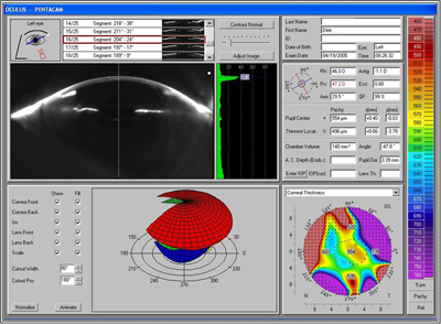 Pentacam results, OS, at 4 months post-operative. There is some increase in interface opacity as measured by densiometry (37.3)