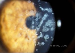 Corneal stromal dystrophies: Macular, Granular, Lattice dystrophy of cornea