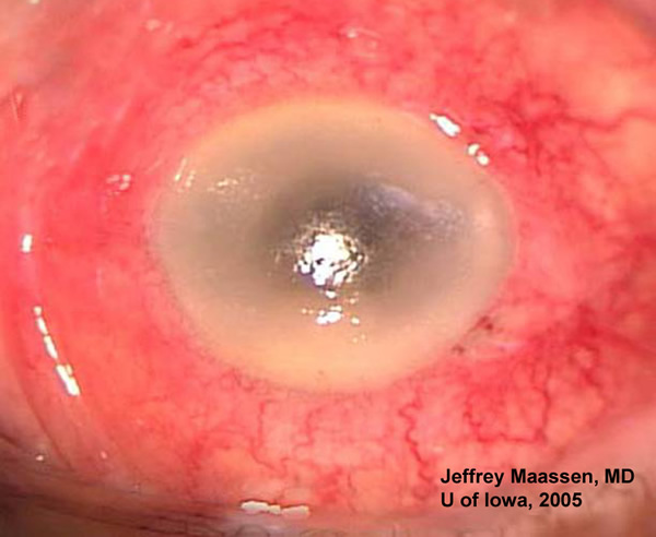 Left eye (OS) status post phacoemulsification and IOL placement 6 days prior. The eye now has profound injection, corneal edema, hypopyon, and fibrin strands in the anterior chamber.