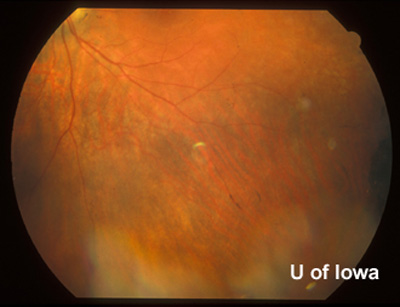 Peripheral fundus, left eye. Small linear clumps of pigment and granular pigment changes. 