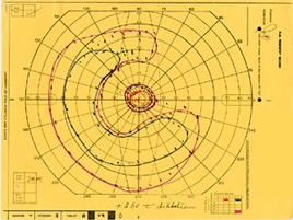 Visual field, OS, in 1985. Ring scotoma is evident 