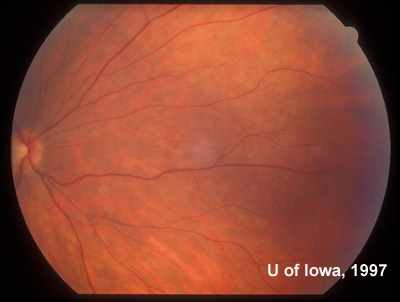 Mid-peripheral view of the fundus in the right eye twenty years after the onset of symptoms in the contralateral eye. No abnormalities were seen. 