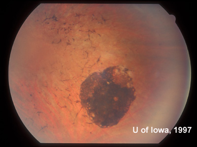 Mid-peripheral view of the fundus in the left eye (adjacent to the CHRPE first documented in 1975). RPE atrophy and bone-spicule changes are evident. The same bone-spicule changes were seen throughout the peripheral fundus of the left eye. 