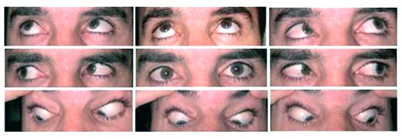 Versions in the nine cardinal gazes at the time of presentation. Note the under-elevation in adduction of the right eye, which is worse in attempted gaze to the patient's upper left