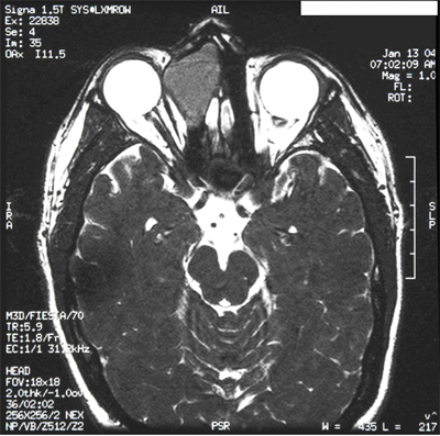 Axial section of T1 contrast MRI showing right-sided ethmoidal mass consistent with a mucocele.