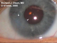 Right eye 2 years after removal of large limbal dermoid (see Figure 1). Residual corneal haze (arrows) indicates the former border of the excised dermoid. 