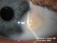 Left eye slit lamp view shows the elevated, fatty appearance of this limbal dermoid. Hair may be seen in these fatty tumors as well.
