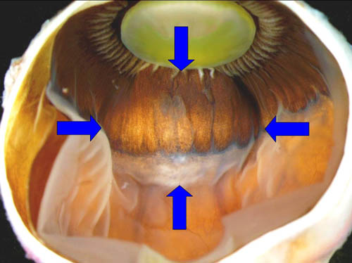 Ciliary body leiomyoma: mass lesions of the choroid and ciliary body 