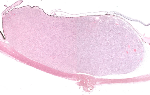 Ciliary body leiomyoma: mass lesions of the choroid and ciliary body 