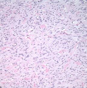 Ciliary body leiomyoma: mass lesions of the choroid and ciliary body