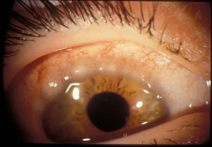 ritgh eye-Broad, gelatinous, thickened, opacified, mucoid nodular infiltrates of eosinophils and epithelial debris. Horner-Trantas Dots (punctiform calcified concretions) are at the apices of the nodules. 