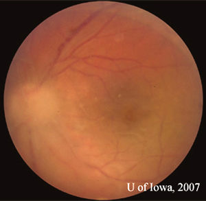 Vitreous inflammation obscures the details of the posterior pole.