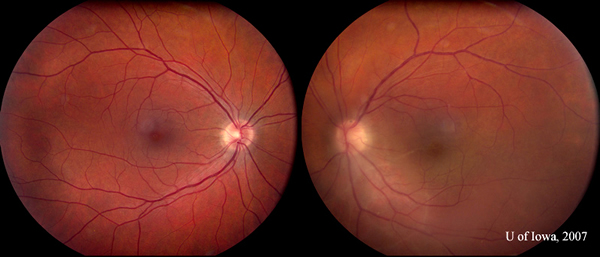 Five weeks after initiating therapy, the right eye remained quiet. Inflammation in the left eye had subsided substantially (compare to inflammation seen in Figure 1B).