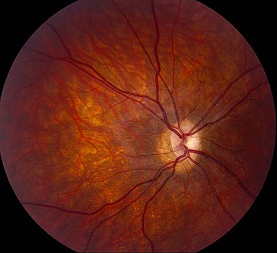 Right Eye- dilated fundus