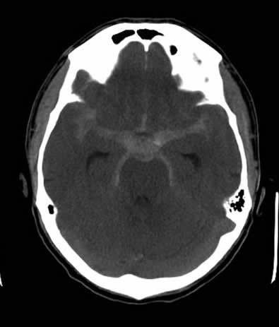CT scan of the brain showing diffuse subarachnoid hemorrhage