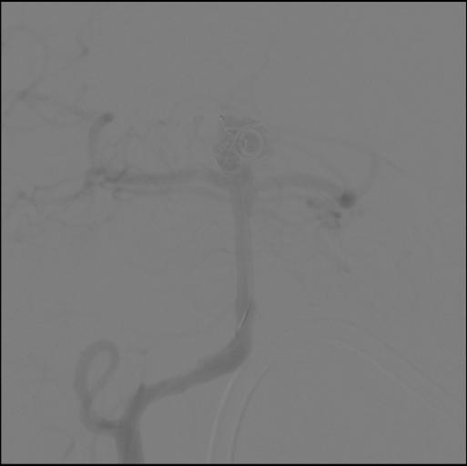 CTA showing basilar artery aneurysm with coil in place