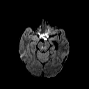 Figure 3A. MRI with DWI (diffusion weighted imaging) showing hyperintense signal in rostral midbrain.