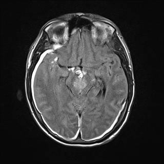 Figure 3C. MRI Flair image showing hyperintensity in the Rostral midbrain