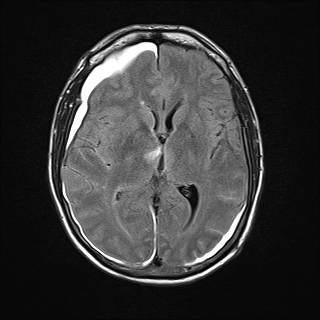 Figure 3D. MRI Flair image showing hyperintensity in the right thalamus. Also note hyperintense signal from subarachnoid hemorrhage