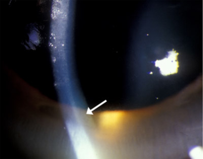 Higher magnification photo of golden brown ring at the level of Descemet's membrane