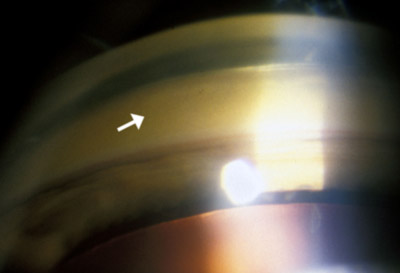 onioscopy of angle, showing golden brown deposit in Descemet's membrane