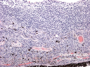 Pathology of Iris Melanoma