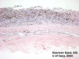 Pathology of Iris Melanoma