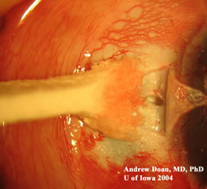 scleral flap