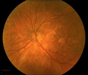 eye demonstrating geographic atrophy and drusen