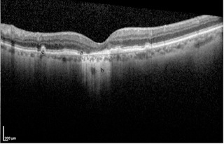  Optical coherence tomography (OCT) image demonstrating geographic atrophy as discontinuity of the RPE