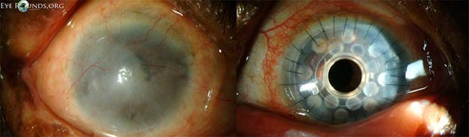 Pre- and post-operative appearance of a Boston Type I KPro device for Stevens-Johnson syndrome. 
