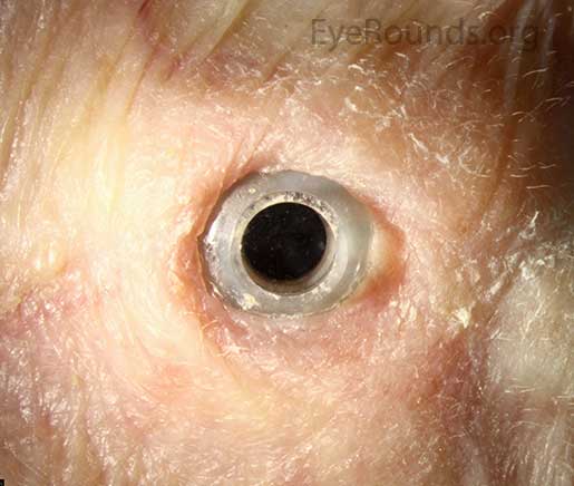 Boston Type II KPro for severe ocular cicatricial pemphigoid 