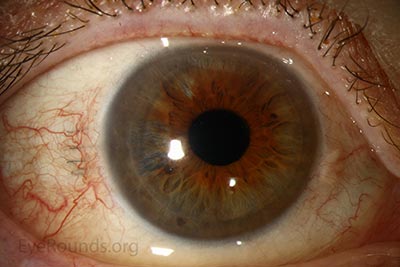 Post-operative appearance after undergoing DSAEK for Fuchs endothelial corneal dystrophy. 