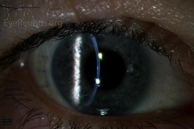 Post-operative appearance after undergoing DSAEK for Fuchs endothelial corneal dystrophy